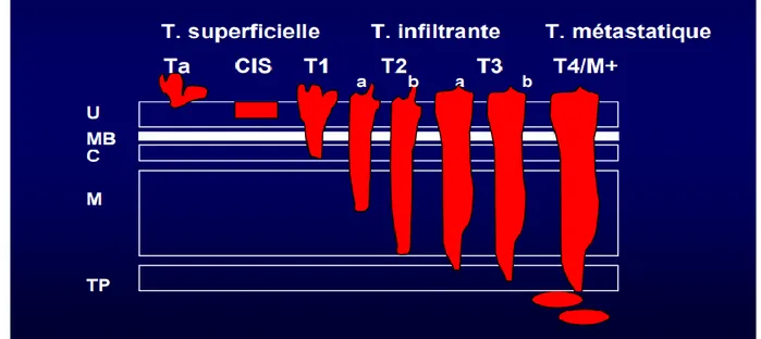 Figure 3. Classification pathologique des tumeurs de vessie(Les tumeurs de vessie,  Dr Vordos service d’urologie Hopital Henri Mondro,Créteil (FMC uro-sexologie)) .