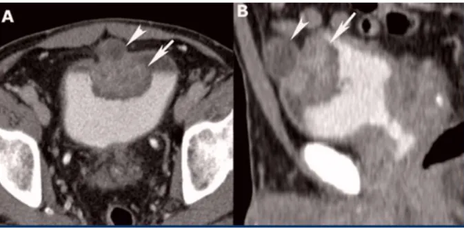 Figure 8. Uroscanner à la phase excrétoire avec injection de furosémide centré sur la vessie  mettant en évidence une tumeur antérieure vésicale sur un reliquat ouraquien