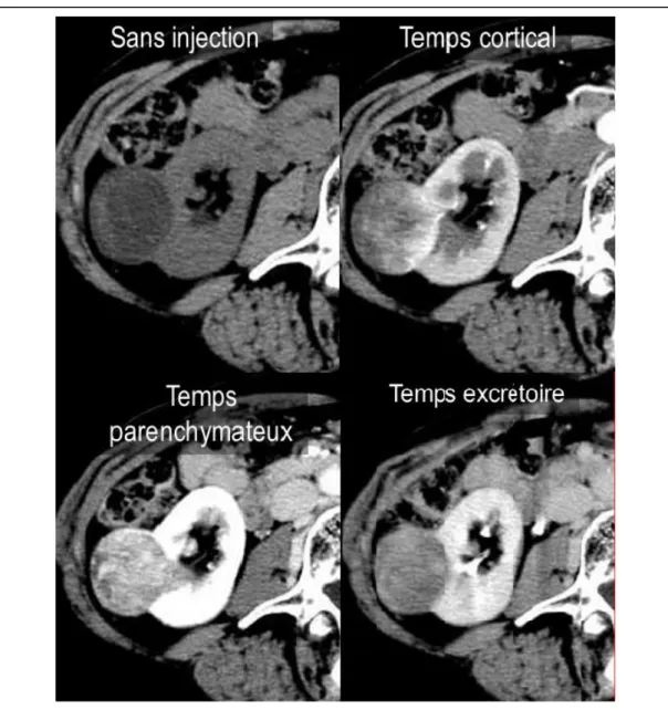 Figure 9. Différentes phases d’un uroscanner dans le cadre d’un carcinome rénal droit