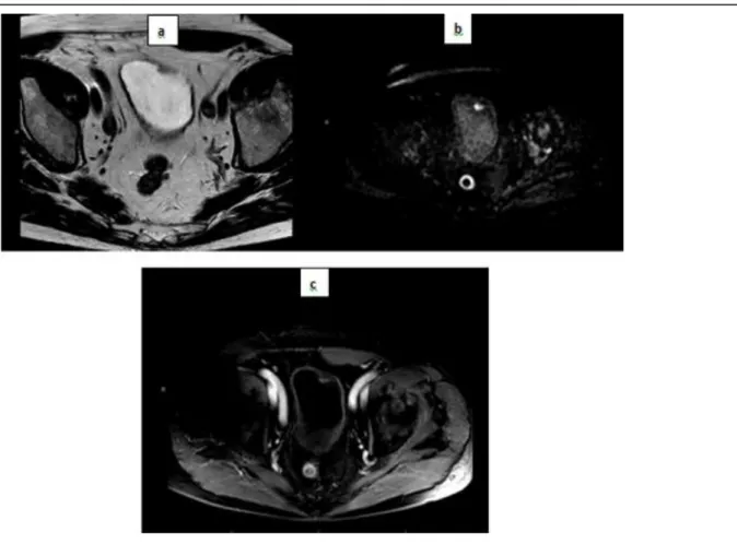Figure 11. IRM de vessie en pondération T2 (a), T1 dynamique (série précoce) (b) et T1  post-injection au temps tardif (c): Tumeur classée pT1G3N0 visible en hyposignal T2 sous  la forme d’une prise de contraste intense au temps précoce avec une inversion 