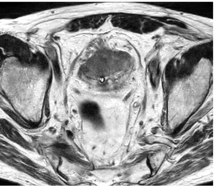 Figure 12. IRM de vessie dans le plan axial en pondération T2: Tumeur de vessie classée  T3b du fait de la présence d’un envahissement de la graisse péri-vésicale antérieure et  antéro-latérale droite sous la forme de  nombreux spicules en hyposignal par r