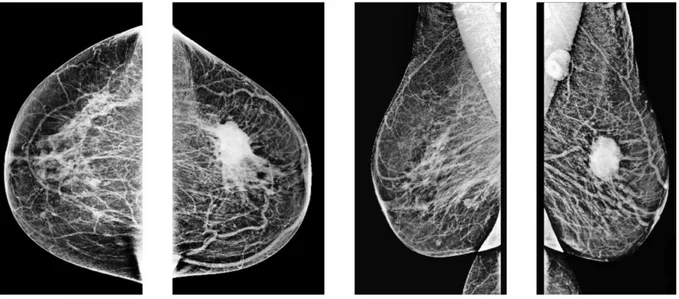 Figure 4 - Faux négatif du modèle avec CAMPs et image de la mammographie correspondante 