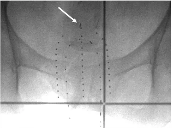 FIGURE  21  –  Exemple  de  cliché  radiographique  effectué  à  chaque  séance  de  curiethérapie afin de contrôler le positionnement de l’applicateur 