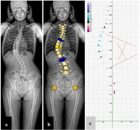 Figure 2 : Radiographie par système EOS 