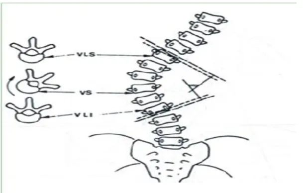 Figure 3 : mesure de l’angle de Cobb.  