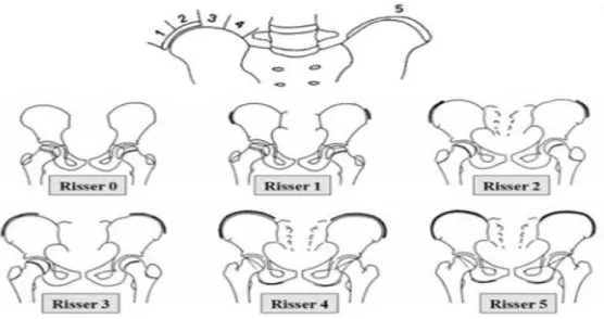 Figure 4 : Classification de Risser 