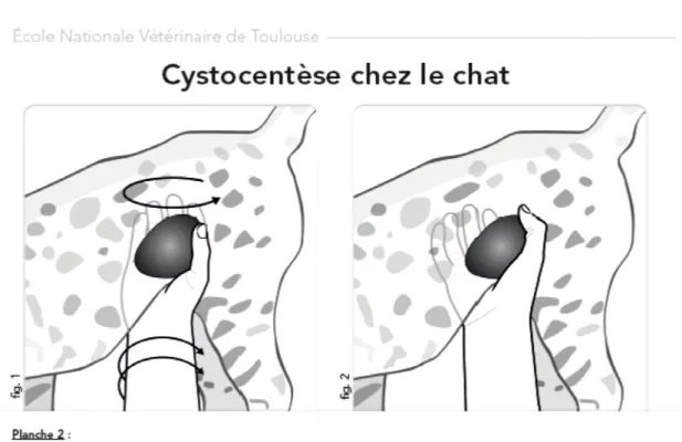 Figure 4 : Planche 2 – Préhension/immobilisation de la vessie pour ponction