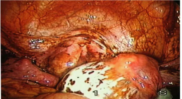 Figure 8 : Implants endométriosiques touchant tous les organes du pelvis [2]
