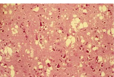 Figure n°6 : Spongiose disséminée à l’intérieur du cortex cérébral, associé à une raréfaction  neuronale chez un patient atteint de la MCJ sporadique