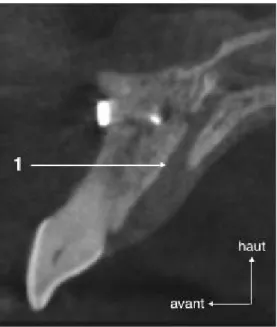 Figure 8  : Coupe scannographique CBCT sagittale médiane centrée sur le maxillaire antérieur
