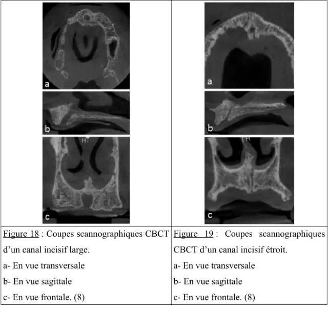 Figure 18 : Coupes scannographiques CBCT d’un canal incisif large.