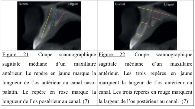 Figure   21 :   Coupe   scannographique sagittale   médiane   d’un   maxillaire antérieur