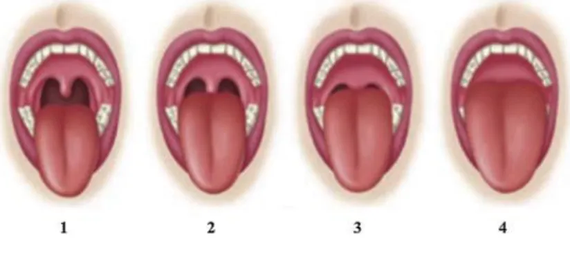 Figure 11 : Score modifié de Mallampati (43)  3.1.3.2.2 Examen de la sécrétion salivaire 