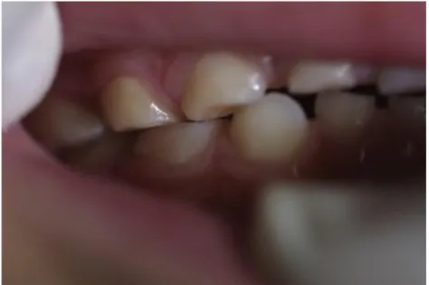 Figure 13 : Dentition d’un patient atteint de bruxisme :                                             usure des dents antagonistes correspondantes (3) 