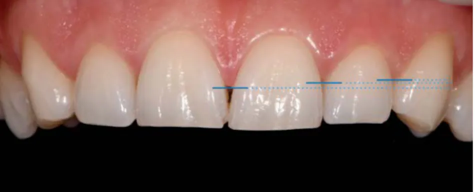 Figure 2: Hauteur des papilles inter dentaires 