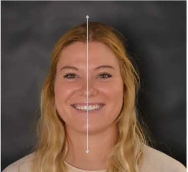 Figure 17: Coïncidence de la ligne sagittale médiane et  de la ligne inter incisive 