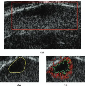 Fig. 9. Log-compressed US images of skin lesion and the corresponding es- es-timated labels (white represents health, red represents lesion)