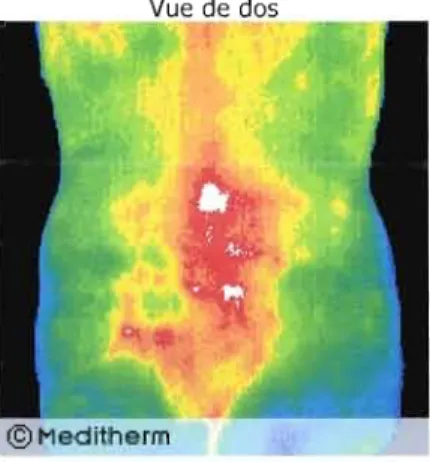 Figure  1.2  Une représentation thermographique d'une patiente qui  a des  douleurs avec  une  implication des  racines nerveuses de  1-2 et 1-3,  tant au  niveau  sensoriel  que  moteur