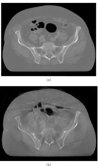 Figure 1.3 – Comparaison de la qualité d’image (a) du CT et (b) du CBCT pour la région pelvienne