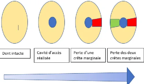 Figure 1 : schéma illustrant l’augmentation du risque de fracture en fonction de la  perte tissulaire corono-radiculaire d’après Meyenberg [2] 