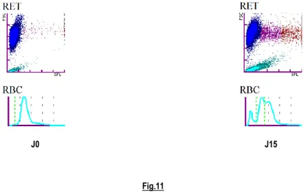 Figure 11 : Cas n°=7, Erythrogrammes réalisés à 15 jours d’intervalle, le second fait suite à la réinduction du protocole de chimiothérapie