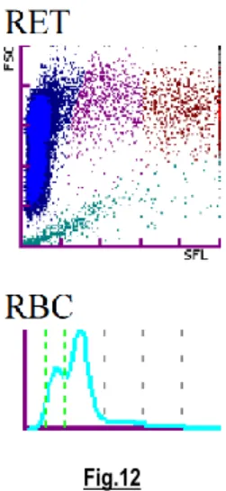Figure 12 : Cas n°=8, Erythrogramme et dot-plot lors de l’admission aux urgences. 