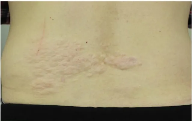 Figure 5 : Plaque en peau de chagrin  D’après Northrup et coll, Pediatr Neurol, 2013 (1) 