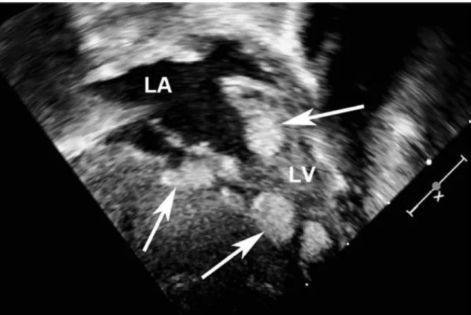 Figure 13 : Rhabdomyomes intracardiaques à l’échographie (flèches blanches)  D’après Northrup et coll, Pediatr Neurol, 2013 (1) 