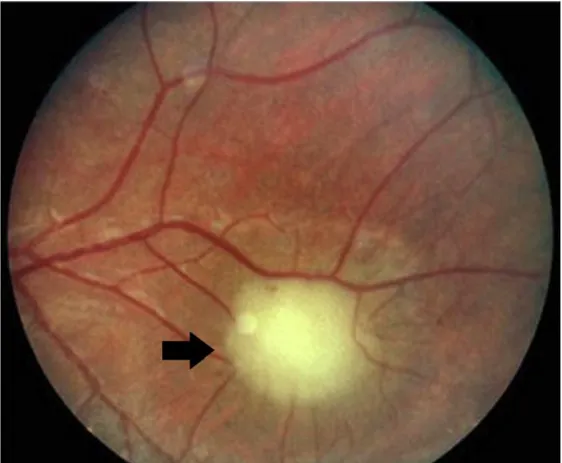 Figure 15 : Phacome rétinien 