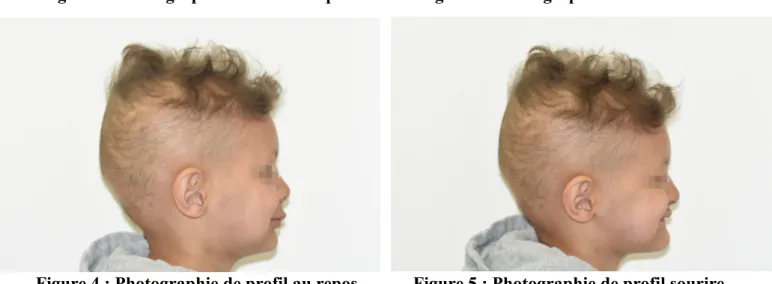 Figure 4 : Photographie de profil au repos Figure 5 : Photographie de profil sourire En exo-buccal, les caractéristiques de la DE sont déjà très présentes. 