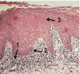 Illustration 5 : Observation au microscope optique d’un lichen plan oral présentant un  infiltrat en bande dans le chorion superficiel (12) 