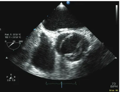 Figure 2-4 : Image échocardiographique de bicuspidie aortique. Coupe transversale à 39° en  échographie transoesophagienne 