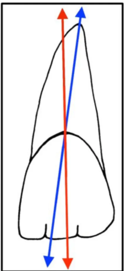 Figure 3 : Axe de l'incisive centrale maxillaire gauche dans le plan frontal : la flèche rouge correspondant à l’axe de la  couronne et la flèche bleu à l’axe de la racine  