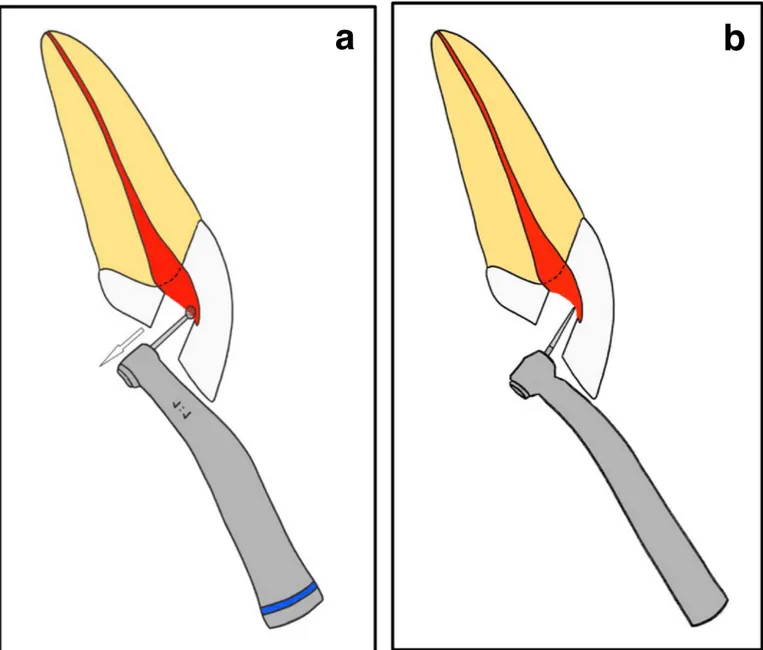 Figure 9 :a.  Effondrement plafond pulpaire à la fraise boule long col sur contre angle bague bleu ; b Effondrement plafond pulpaire à la fraise  fissure bout mousse sur turbine (proportions non respectées) 