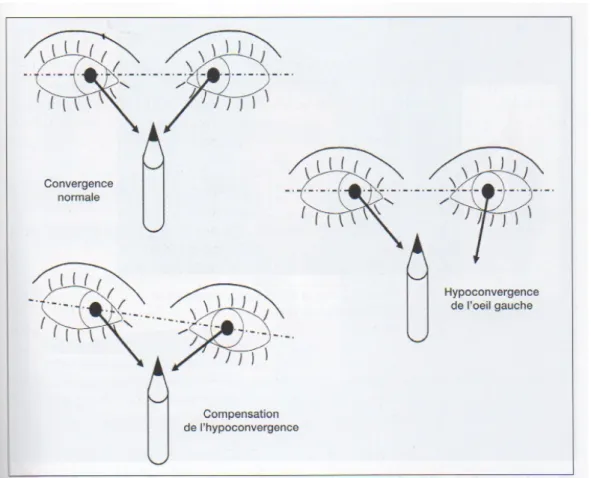 Figure 12 : Schéma des résultats possibles du test de convergence du  crayon (4). 