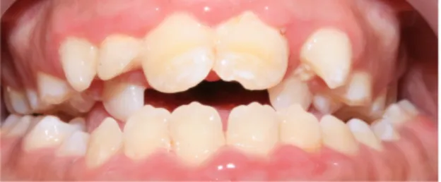 Figure 4: Patient avec une suspicion d'endognathie maxillaire et une béance antérieure, l’encombrement maxillaire  est ici important, iconographie personnelle 