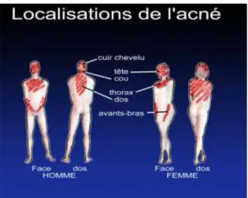 Figure 1 : Localisations de l’acné (3) 