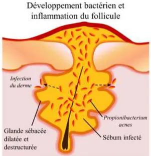Figure 6 : Développement bactérien et inflammation du follicule (10) 