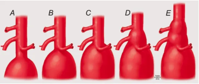 Figure 1  A-E:  Classification  anatomique  des  anévrysmes  aortiques  complexes  (© 