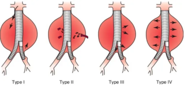 Figure  5 : Illustration  des  types  d’endofuites  (EF)  rencontrés  après  EVAR. Les  EF  de  type  1  sont  des  fuites  proximales  ou  distales  au  niveau  des  zones  d’étanchéité  de  l’endoprothèse