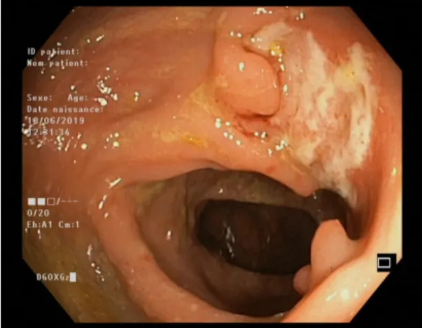 Figure 1 : Photographie par coloscopie montrant un large ulcère de la muqueuse du  colon