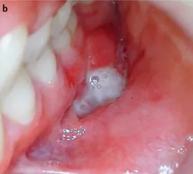 Figure 14 : Photographie intraorale d’une ulcération linéaire profonde du fond de  vestibule mandibulaire gauche chez une patiente de 13 ans atteinte de maladie de Crohn 