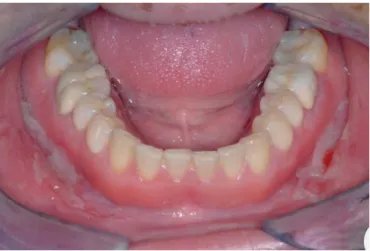 Figure 17 : Photographie intraorale d’une lésion d’aspect pavimenteux localisée dans la  face interne de la joue chez un patient de 20 ans atteint de maladie de Crohn 