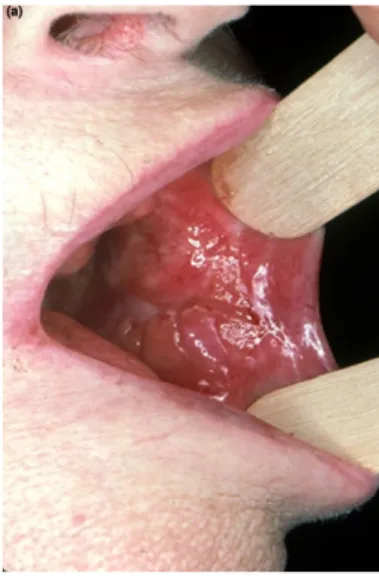 Figure 19 : Photographie d’une pyostomatite végétante localisé sur la face dorsale de la  langue chez un patient atteint de maladie de Crohn (47)