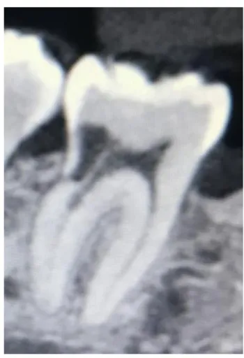 Figure 10 : Image de résorption d’une molaire mandibulaire sur un  CBCT. (image issue de la base de données) 