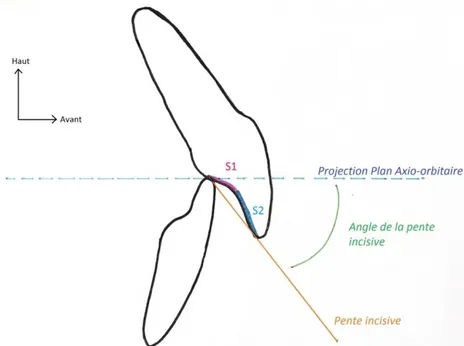 Figure 6 : Schématisation de la pente incisive avec les segments S1 et S2 selon une  coupe sagittale (illustration personnelle) 