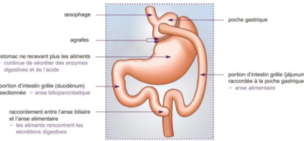 Figure 5 : technique du bypass gastrique (ou court-circuit gastrique). HAS, 2009. 22