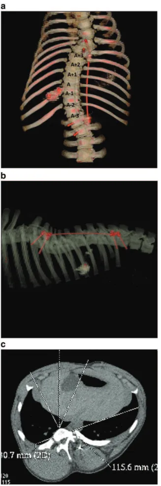 Fig. 3. Final CT scan demonstrating a scoliosis-like deformity (a) — Coronal reconstruction with a 42° right thoracic curve