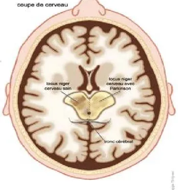 Figure n°2 : Coupe de cerveau, locus niger (substance noire) d’un cerveau sain  et locus niger d’un cerveau atteint de la maladie  de Parkinson