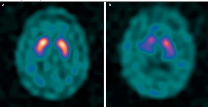 Figure n°6 : Les transporteurs de dopamine  chez un patient sans Parkinson  (à  gauche) et chez un patient atteint de la maladie  de Parkinson d’apparition  précoce (à droite) 